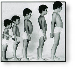 Duchenne Image from http://connect.in.com/duchenne-muscular-dystrophy/photos-duchenne-aff74b22d0e52ee0.html